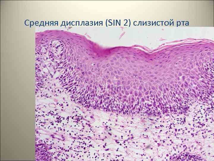 Средняя дисплазия (SIN 2) слизистой рта 29 