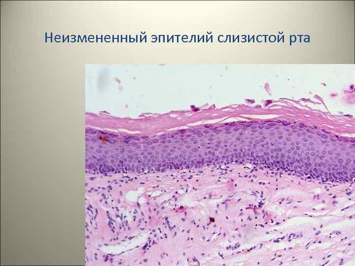 Неизмененный эпителий слизистой рта 3 