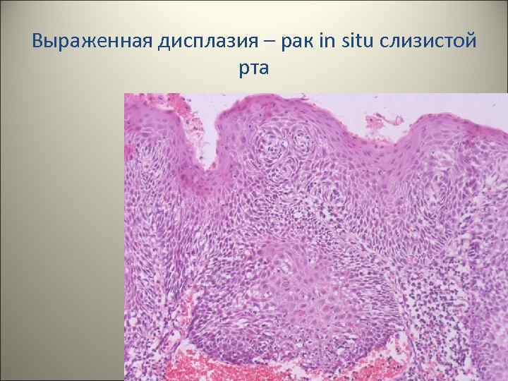 Выраженная дисплазия – рак in situ слизистой рта 30 