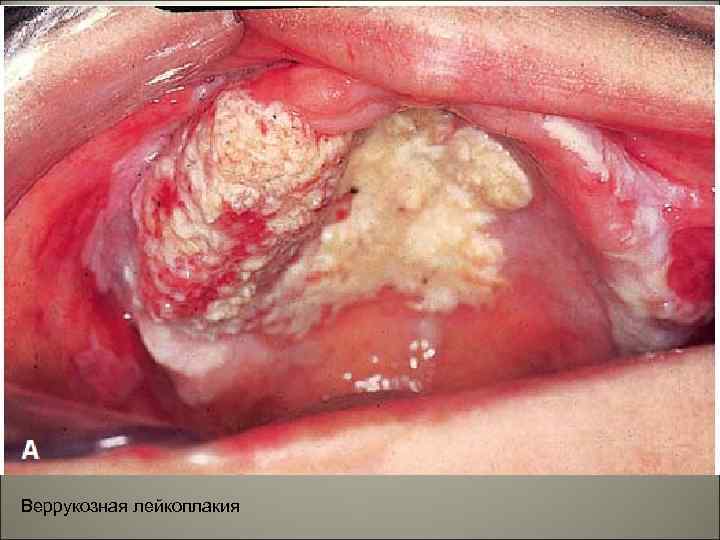 Веррукозная лейкоплакия 