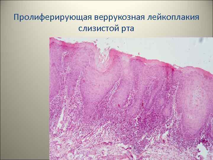 Пролиферирующая веррукозная лейкоплакия слизистой рта 34 