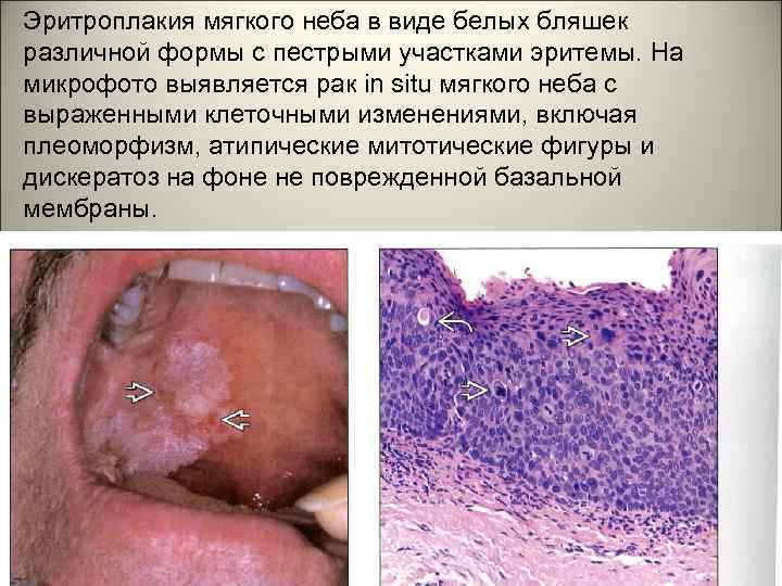 Эритроплакия мягкого неба в виде белых бляшек различной формы с пестрыми участками эритемы. На