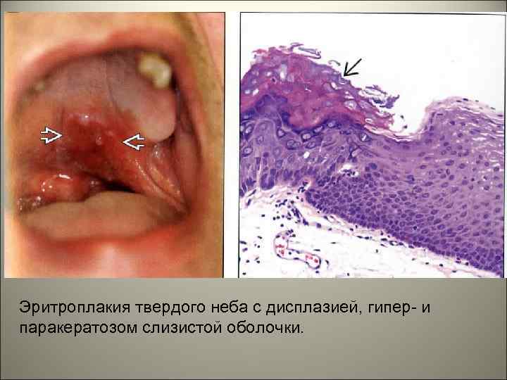 Эритроплакия твердого неба с дисплазией, гипер- и паракератозом слизистой оболочки. 