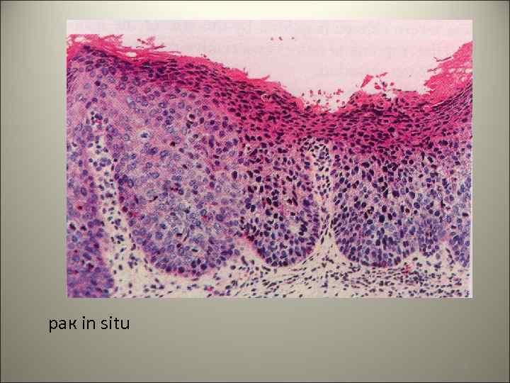 рак in situ 48 
