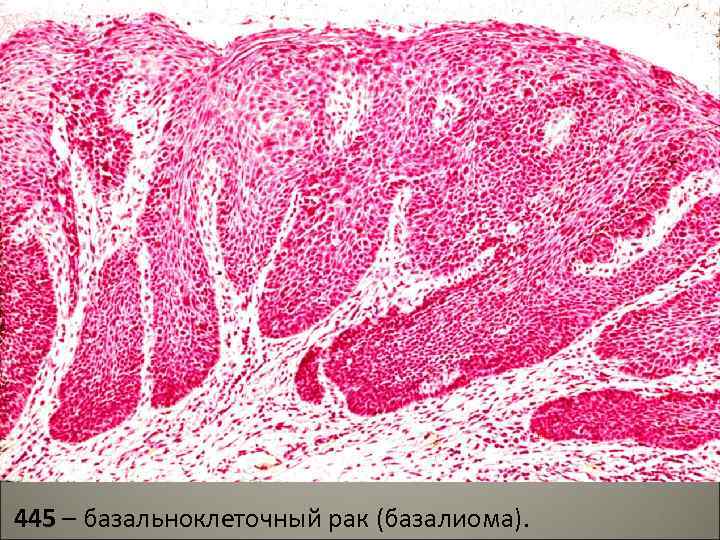 445 – базальноклеточный рак (базалиома). 52 