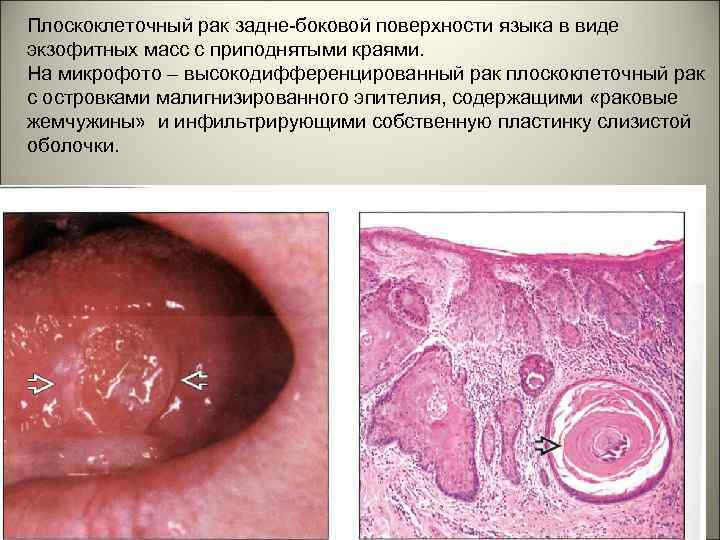 Плоскоклеточный рак задне-боковой поверхности языка в виде экзофитных масс с приподнятыми краями. На микрофото