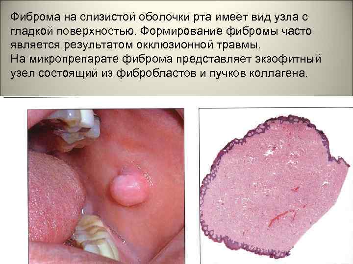 Фиброма на слизистой оболочки рта имеет вид узла с гладкой поверхностью. Формирование фибромы часто