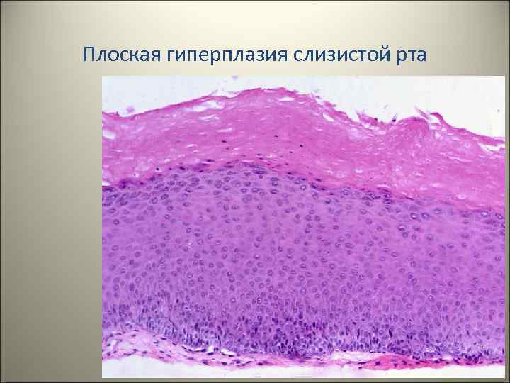 Плоская гиперплазия слизистой рта 6 