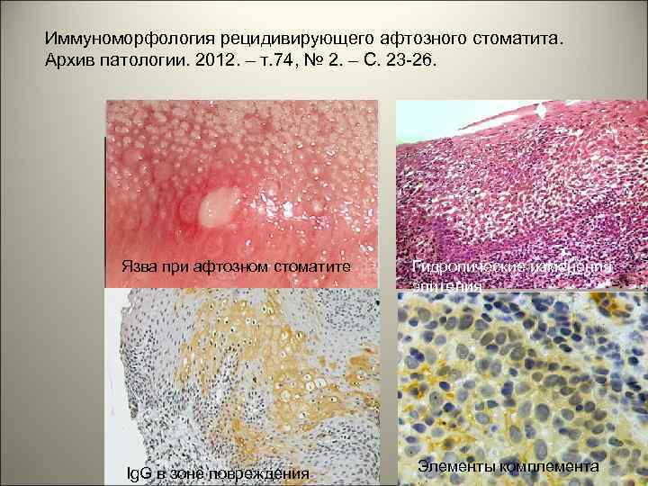 Иммуноморфология рецидивирующего афтозного стоматита. Архив патологии. 2012. – т. 74, № 2. – С.