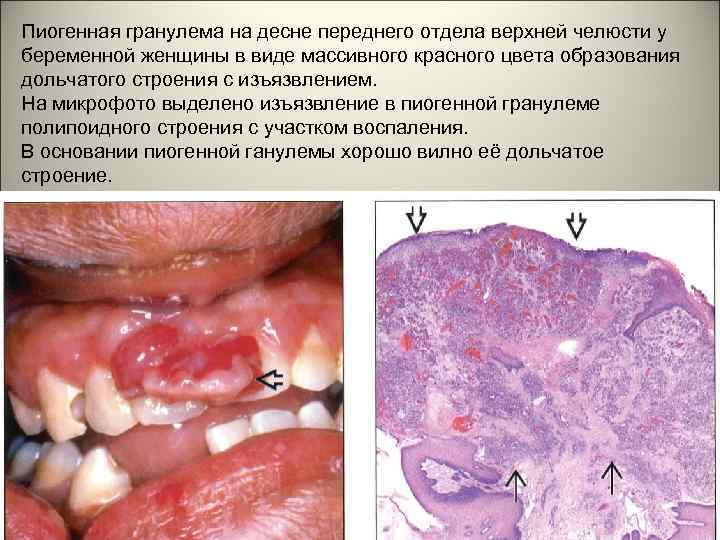 Пиогенная гранулема на десне переднего отдела верхней челюсти у беременной женщины в виде массивного