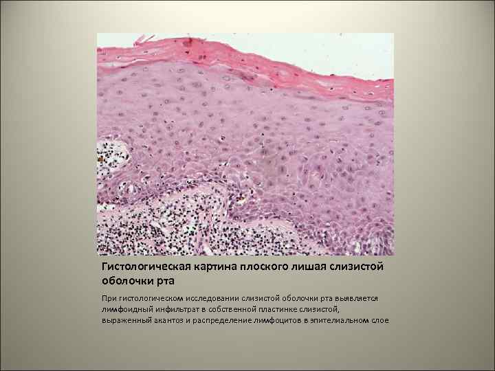 Гистологическая картина плоского лишая слизистой оболочки рта При гистологическом исследовании слизистой оболочки рта выявляется