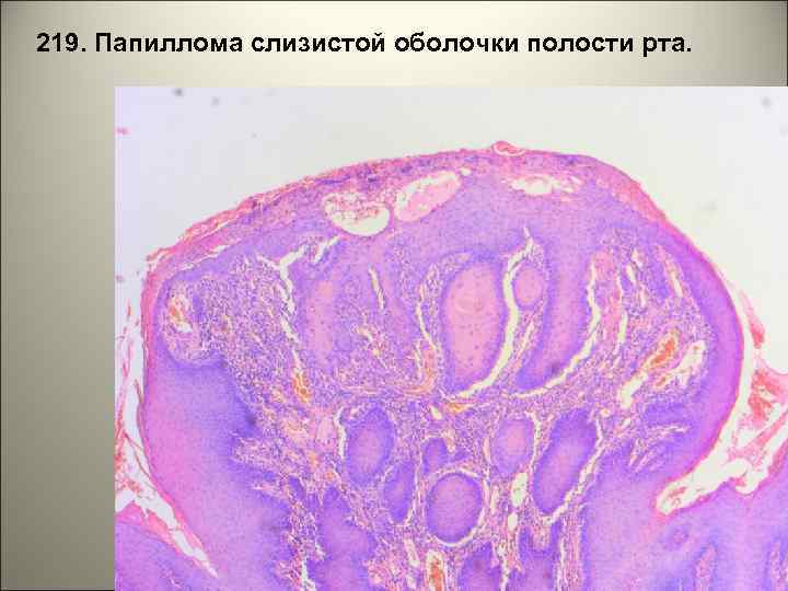 219. Папиллома слизистой оболочки полости рта. 