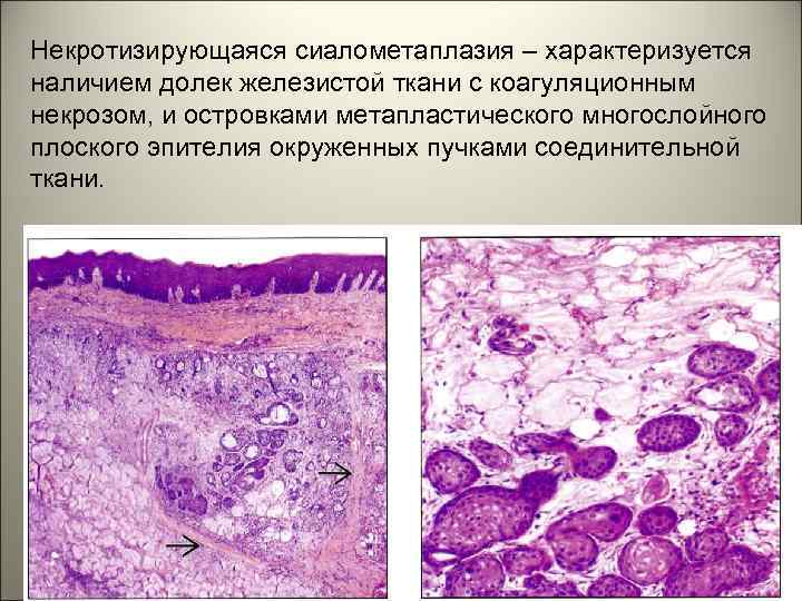 Некротизирующаяся сиалометаплазия – характеризуется наличием долек железистой ткани с коагуляционным некрозом, и островками метапластического