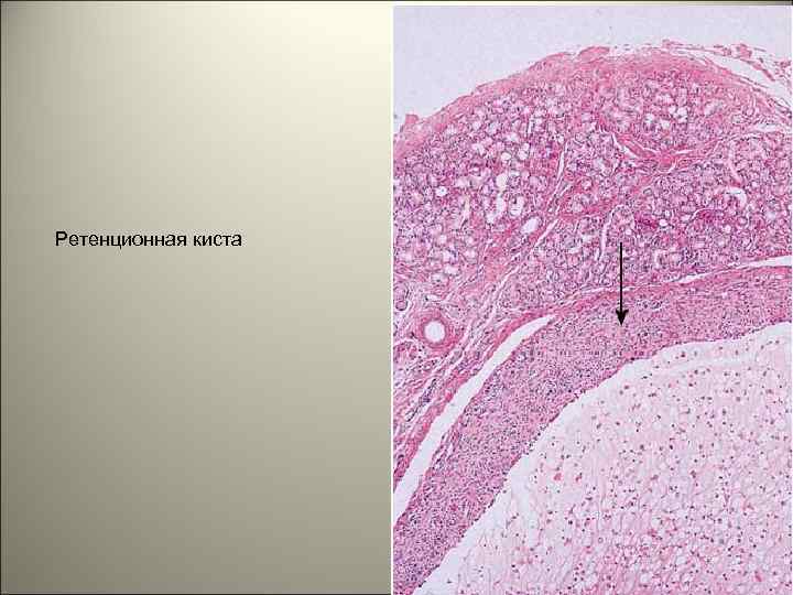 Ретенционная киста 