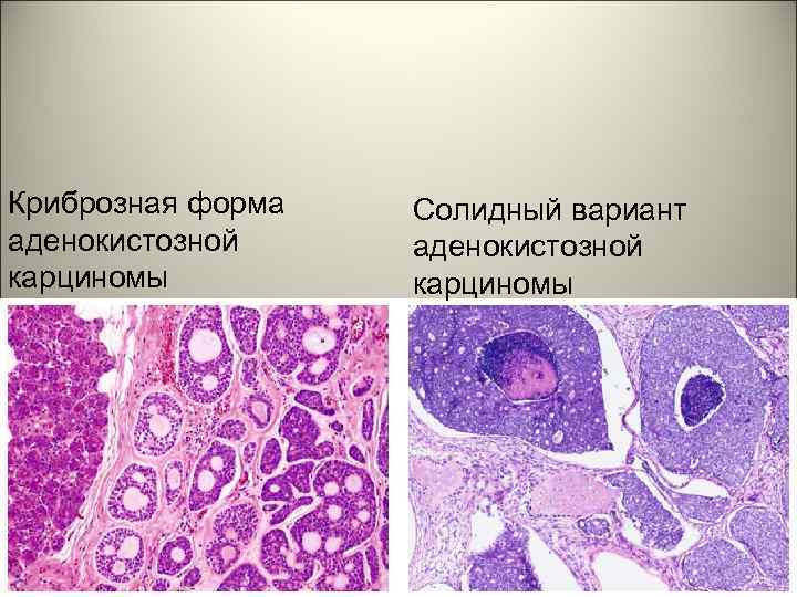 Криброзная форма аденокистозной карциномы Солидный вариант аденокистозной карциномы 
