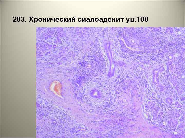 203. Хронический сиалоаденит ув. 100 