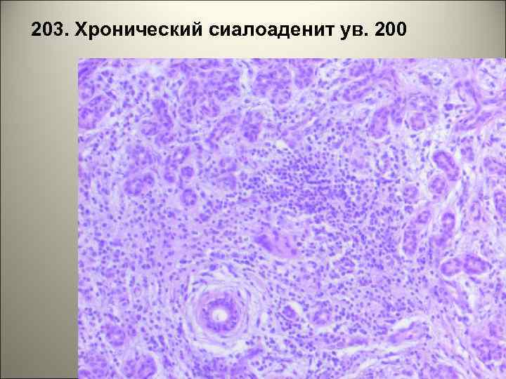 203. Хронический сиалоаденит ув. 200 