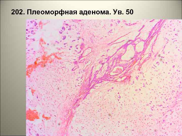 202. Плеоморфная аденома. Ув. 50 