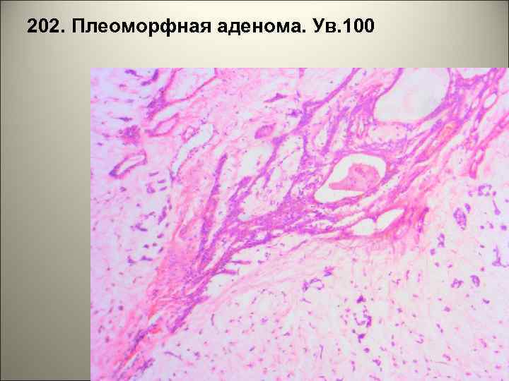 202. Плеоморфная аденома. Ув. 100 