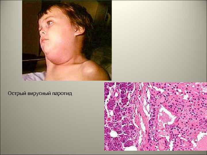 Острый вирусный паротид 