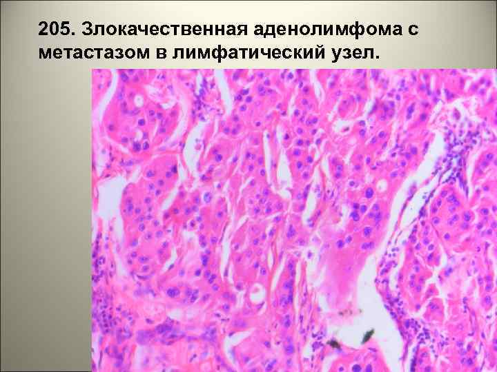205. Злокачественная аденолимфома с метастазом в лимфатический узел. 