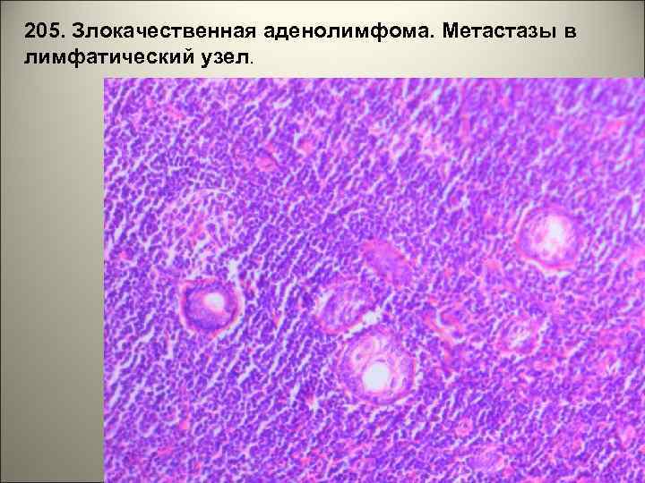 205. Злокачественная аденолимфома. Метастазы в лимфатический узел. 