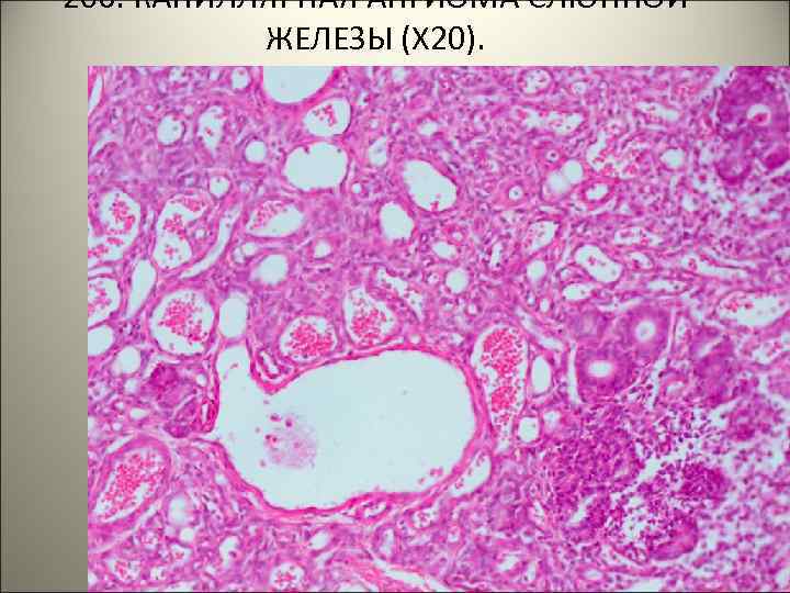 206. КАПИЛЛЯРНАЯ АНГИОМА СЛЮННОЙ ЖЕЛЕЗЫ (Х 20). . 