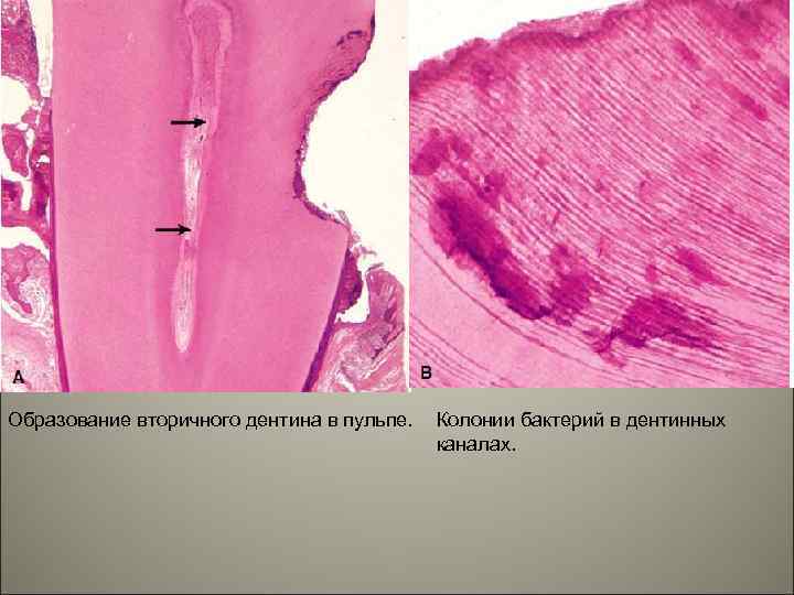 Образование вторичного дентина в пульпе. Колонии бактерий в дентинных каналах. 