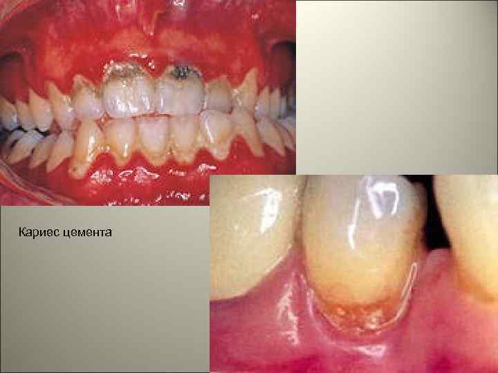 Кариес цемента 