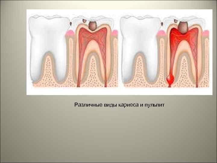 Различные виды кариеса и пульпит 