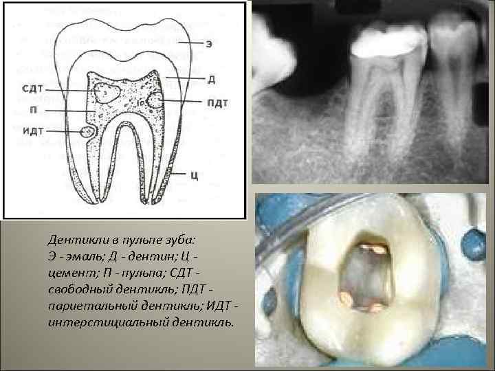 Дентикли в пульпе зуба: Э - эмаль; Д - дентин; Ц цемент; П -