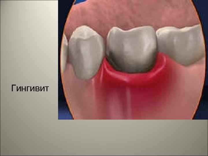 Гингивит 