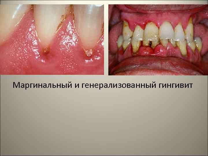 Маргинальный и генерализованный гингивит 
