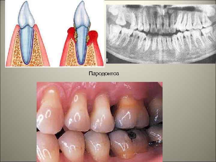 Пародонтоз 