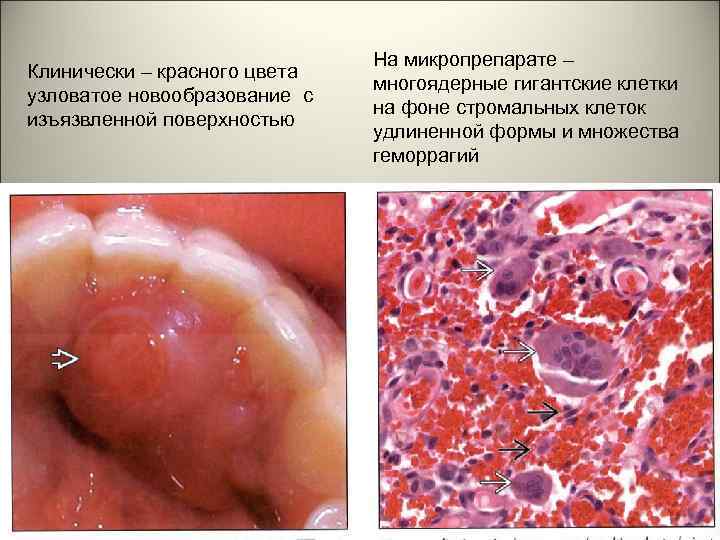 Клинически – красного цвета узловатое новообразование с изъязвленной поверхностью На микропрепарате – многоядерные гигантские