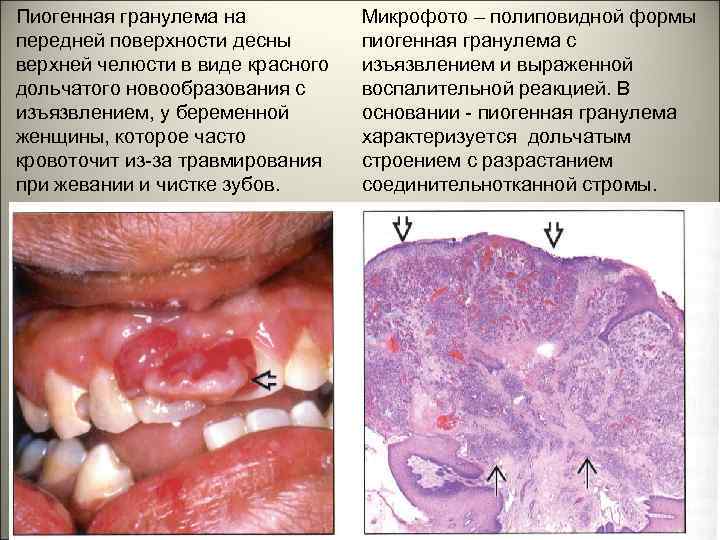 Пиогенная гранулема на передней поверхности десны верхней челюсти в виде красного дольчатого новообразования с