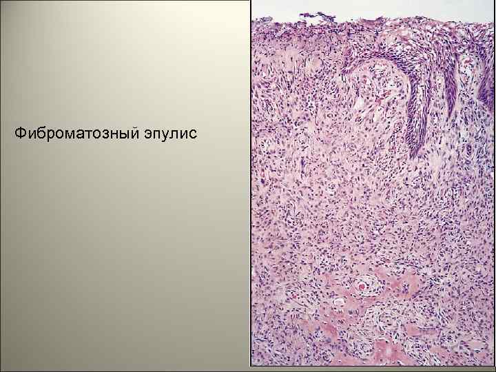 Фиброматозный эпулис 