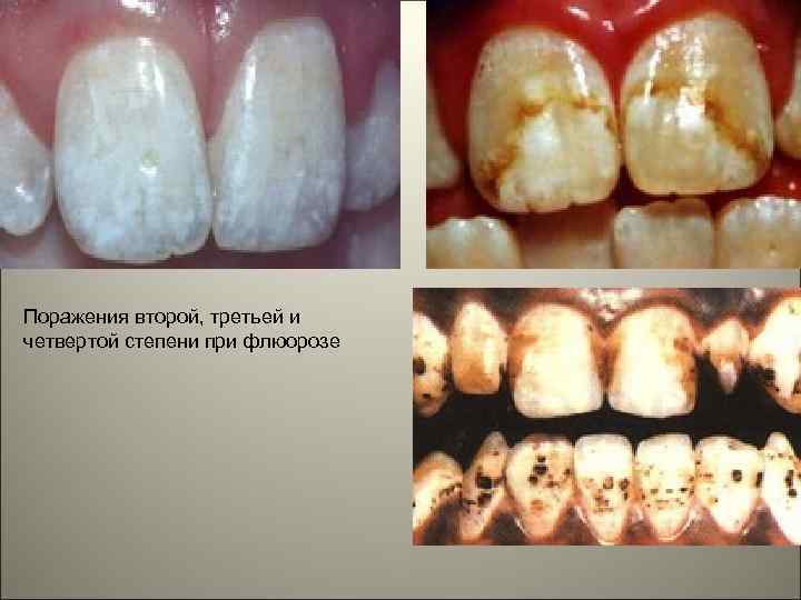 Поражения второй, третьей и четвертой степени при флюорозе 