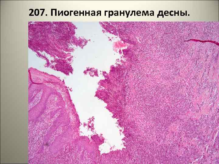 207. Пиогенная гранулема десны. 