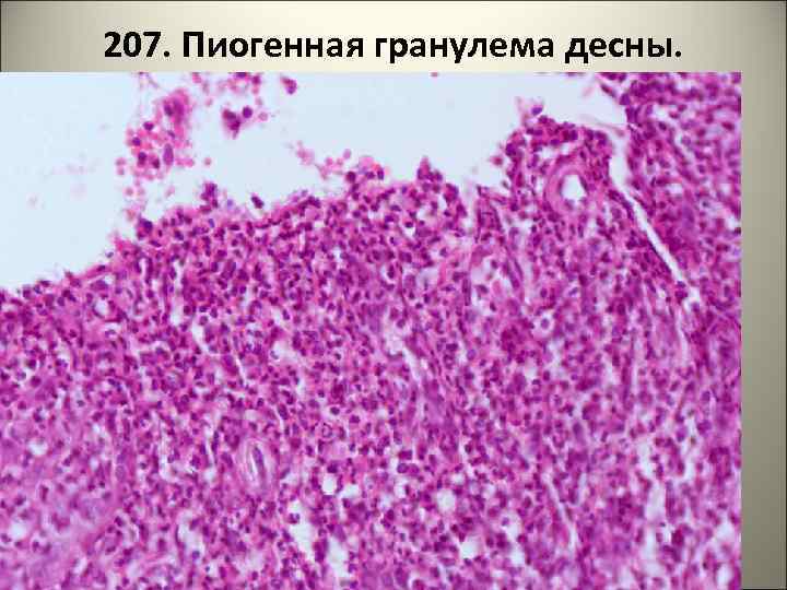 207. Пиогенная гранулема десны. 