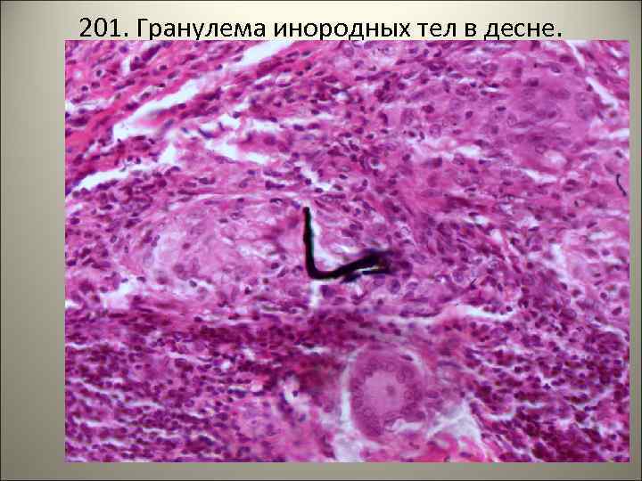 201. Гранулема инородных тел в десне. 