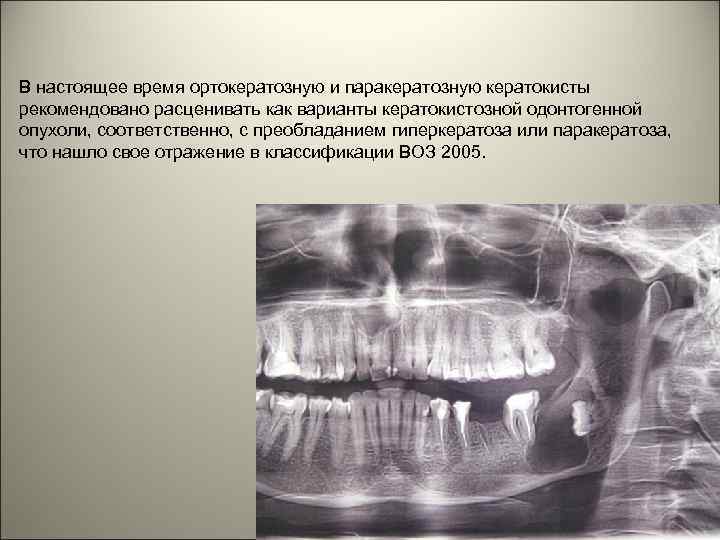 В настоящее время ортокератозную и паракератозную кератокисты рекомендовано расценивать как варианты кератокистозной одонтогенной опухоли,