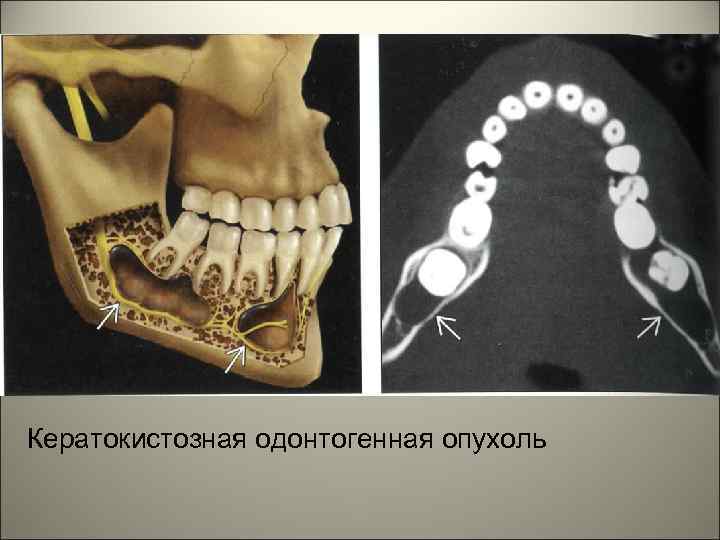 Кератокистозная одонтогенная опухоль 