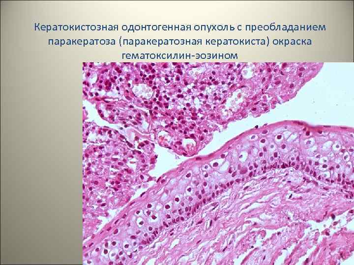 Кератокистозная одонтогенная опухоль с преобладанием паракератоза (паракератозная кератокиста) окраска гематоксилин-эозином 30 