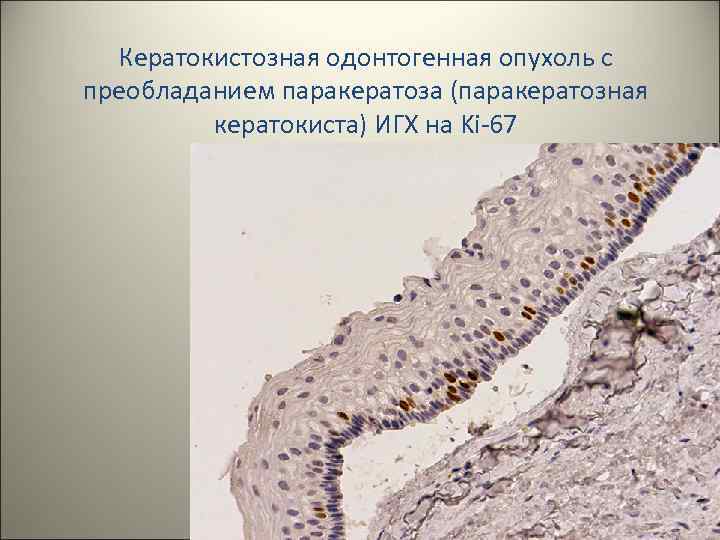 Кератокистозная одонтогенная опухоль с преобладанием паракератоза (паракератозная кератокиста) ИГХ на Ki-67 31 