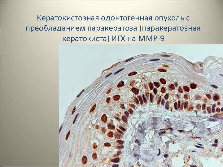 Кератокистозная одонтогенная опухоль с преобладанием паракератоза (паракератозная кератокиста) ИГХ на MMP-9 32 