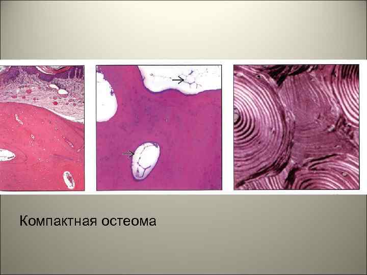 Компактная остеома 
