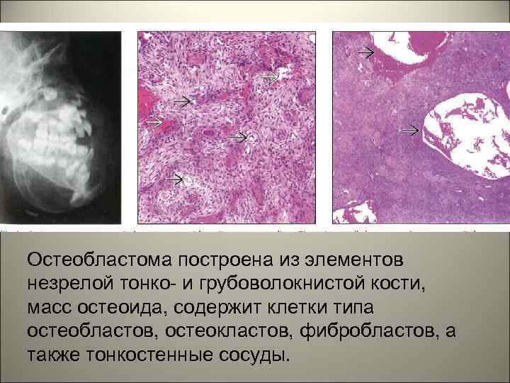 Остеобластома построена из элементов незрелой тонко- и грубоволокнистой кости, масс остеоида, содержит клетки типа