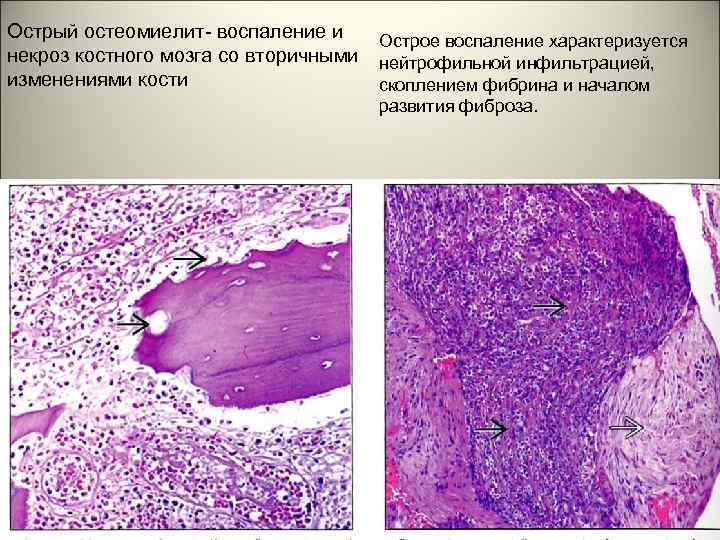 Острый остеомиелит- воспаление и Острое воспаление характеризуется некроз костного мозга со вторичными нейтрофильной инфильтрацией,