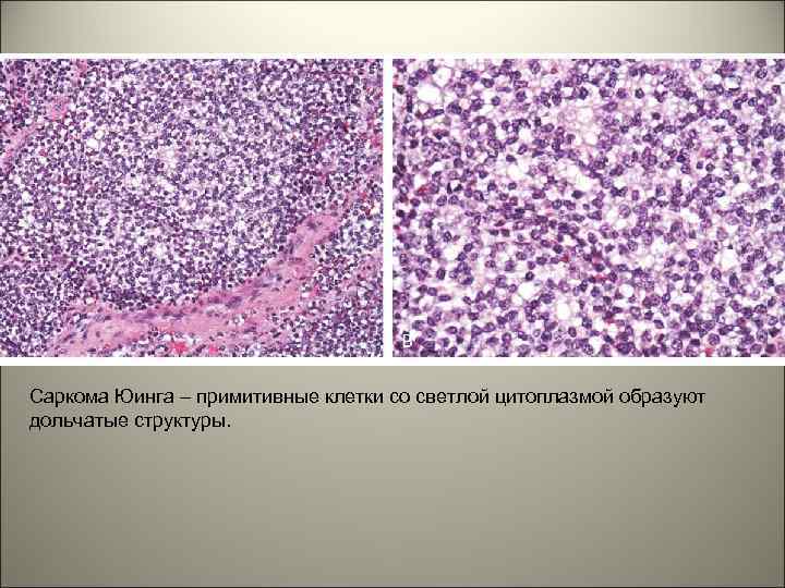 Саркома Юинга – примитивные клетки со светлой цитоплазмой образуют дольчатые структуры. 